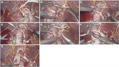 A single-center initial experience on laparoscopic pancreatic operation combined with hepatic arterial resection and reconstruction